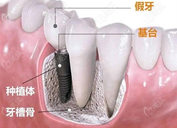 種半口種植牙是什么感覺呢 種半口種植牙是什么感覺呢