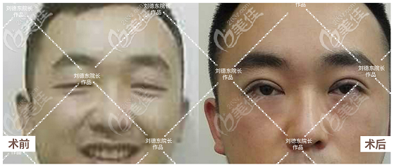 劉德東做雙眼皮怎么樣 劉德東做雙眼皮怎么樣