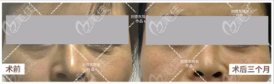 劉德東醫(yī)生自體脂肪填充淚溝案例 劉德東醫(yī)生自體脂肪填充淚溝案例