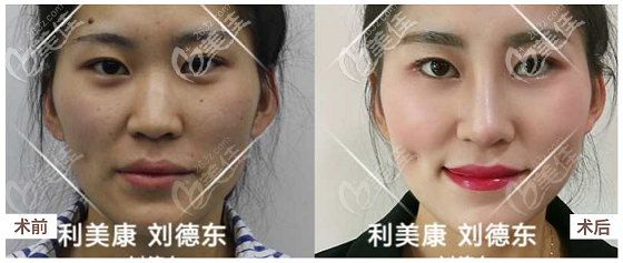 劉德東鼻綜合案例 劉德東鼻綜合案例