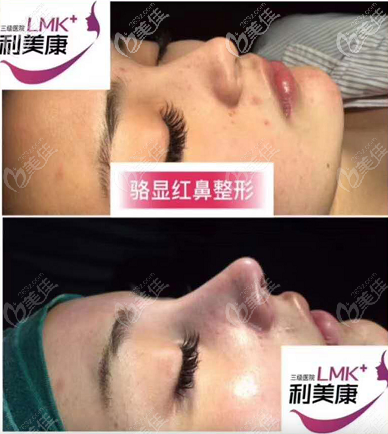 貴州利美康鼻綜合案例 貴州利美康鼻綜合案例