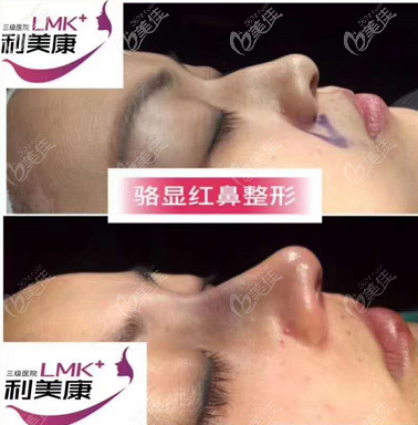 駱顯紅醫(yī)生駝峰鼻矯正案例 駱顯紅醫(yī)生駝峰鼻矯正案例