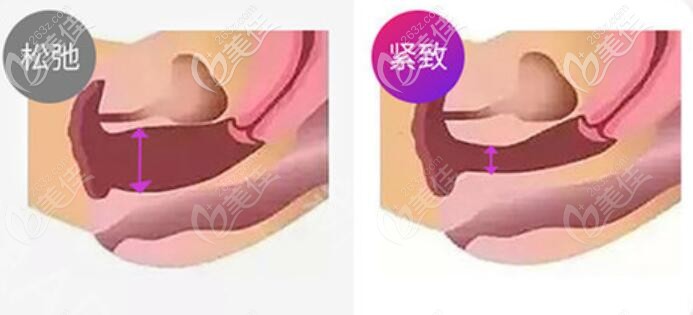 歐洲之星fonota4d縮陰效果前后對比圖 歐洲之星fonota4d縮陰效果前后對比圖