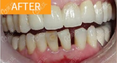 在深圳博愛曙光口腔種牙時,我選的是美國3i種植體品牌!13000多一顆!