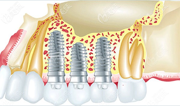 種植體國產(chǎn)和進口的區(qū)別大嗎 種植體國產(chǎn)和進口的區(qū)別大嗎