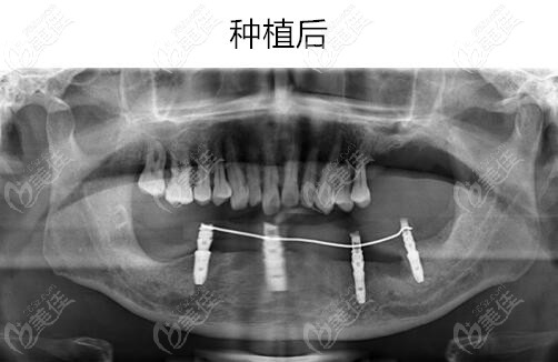 70歲老爹剛在寧波牙博士做了allon4下半口即刻種植牙，雖然價格貴了點(diǎn)但效果真贊