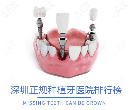 深圳正規(guī)種植牙醫(yī)院排行榜來啦,都是種牙技術(shù)靠譜的醫(yī)院哦 深圳正規(guī)種植牙醫(yī)院排行榜來啦,都是種牙技術(shù)靠譜的醫(yī)院哦