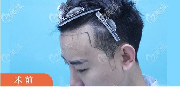 發(fā)際線種植前的方案設計圖 發(fā)際線種植前的方案設計圖