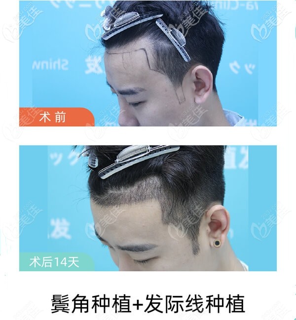 男士種植發(fā)際線效果圖片 男士種植發(fā)際線效果圖片