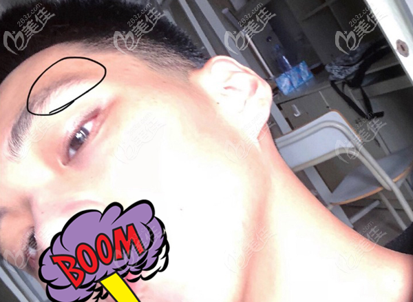 眉毛種植之前的效果圖 眉毛種植之前的效果圖