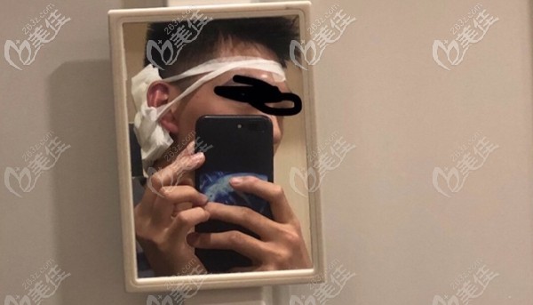 眉毛種植術(shù)后即刻效果 眉毛種植術(shù)后即刻效果