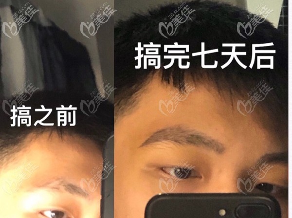 眉毛種植前后對(duì)比圖 眉毛種植前后對(duì)比圖