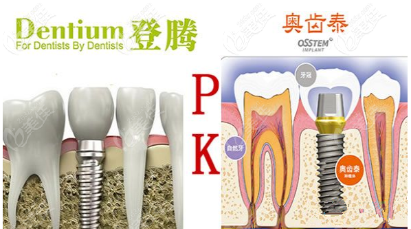韓國登騰與奧齒泰優(yōu)劣對比 韓國登騰與奧齒泰優(yōu)劣對比