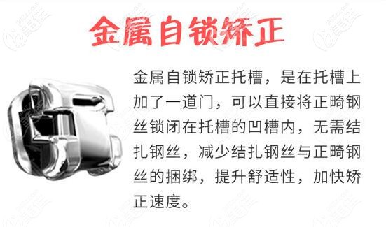 唐山牙博士口腔金屬自鎖托槽