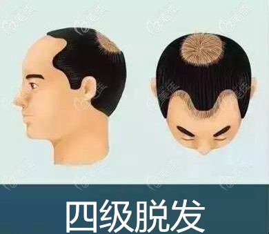 4級地中海脫發(fā)面積