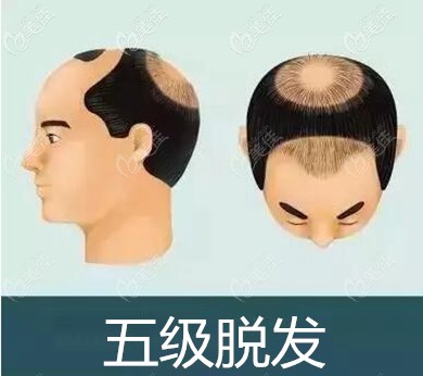 地中海5級脫發(fā)面積