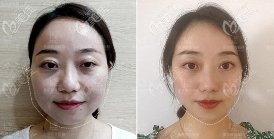 重慶聯(lián)合麗格瘦臉+面部提升案例 重慶聯(lián)合麗格瘦臉+面部提升案例