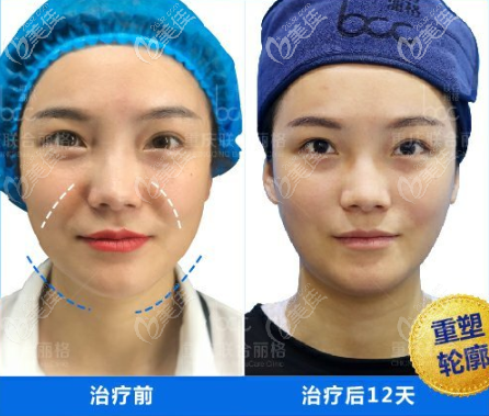 面部輪廓重塑案例 面部輪廓重塑案例