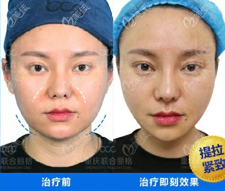 重慶聯(lián)合麗格面部提升案例 重慶聯(lián)合麗格面部提升案例