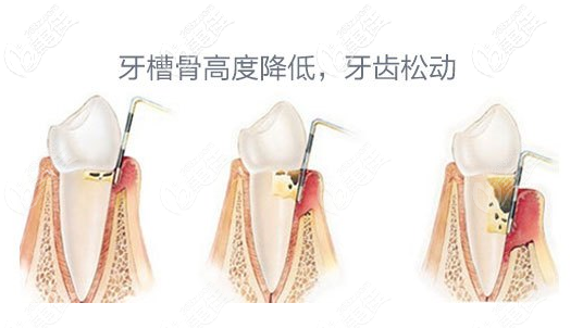 牙槽骨萎縮的樣子