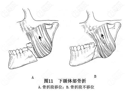 頜骨骨折圖片 頜骨骨折圖片