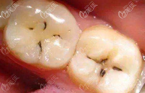 齲壞的牙齒圖片 齲壞的牙齒圖片