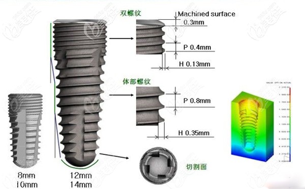 韓國迪奧DIO種植體介紹 韓國迪奧DIO種植體介紹