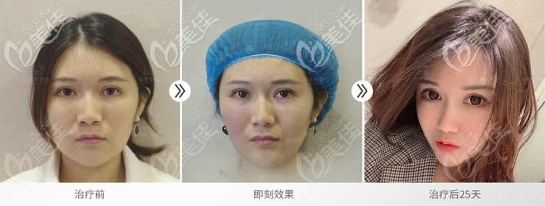 重慶鄭荃麗格自體脂肪修復(fù)案例 重慶鄭荃麗格自體脂肪修復(fù)案例