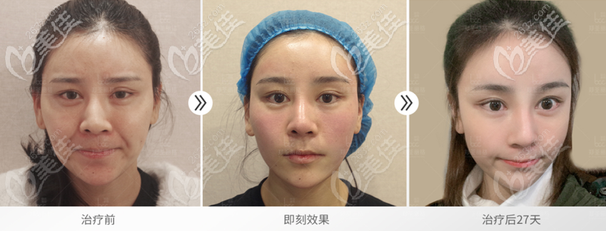 鄭荃院長(zhǎng)RNT脂肪修復(fù)案例 鄭荃院長(zhǎng)RNT脂肪修復(fù)案例