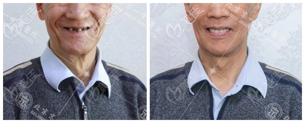 滿口種植牙前后<span style= 滿口種植牙前后<span style=