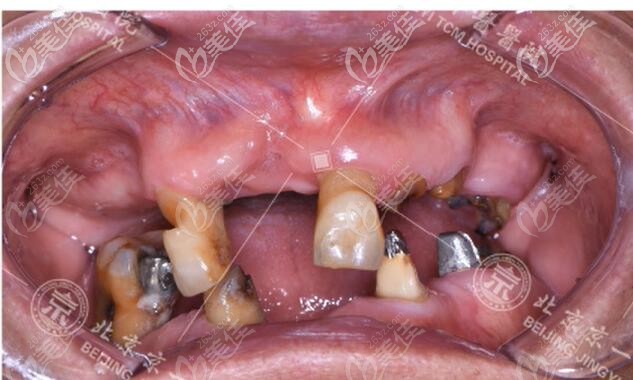全口多顆牙缺失口腔情況 全口多顆牙缺失口腔情況