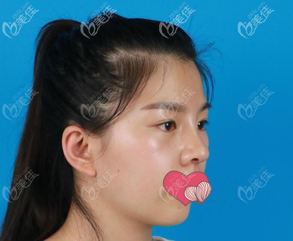 半肋骨鼻綜合15天弧度很自然