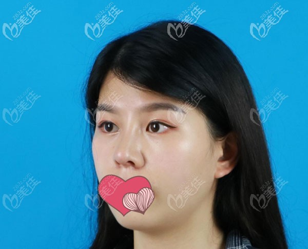 肋軟骨隆鼻一個月鼻小柱位置有點紅