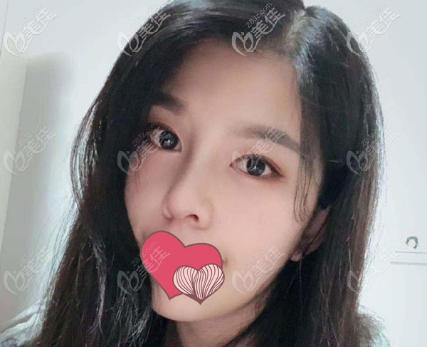 隆鼻術后40天鼻頭已經(jīng)有觸感