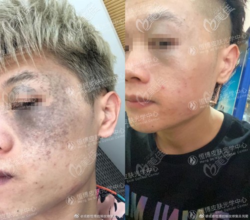 成都恒博去太田痣真人案例