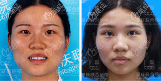 重慶聯(lián)合麗格做激光祛黃褐斑后反黑5個月的可能性很小，價位也不高