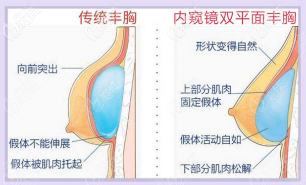 梅州曙光內(nèi)窺鏡雙平面隆胸技術(shù)優(yōu)勢 梅州曙光內(nèi)窺鏡雙平面隆胸技術(shù)優(yōu)勢