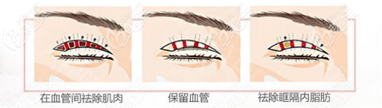 李耐國(guó)做雙眼皮手術(shù)的優(yōu)勢(shì) 李耐國(guó)做雙眼皮手術(shù)的優(yōu)勢(shì)