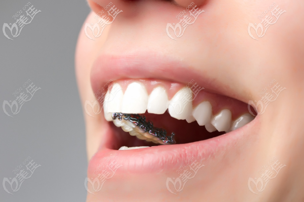 北京舌側(cè)矯正哪個醫(yī)生好?北京能做舌側(cè)矯正的醫(yī)院醫(yī)生都在這里了