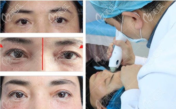 連天美做熱瑪吉除皺的效果