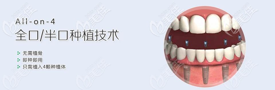 全口半口種植圖片 全口半口種植圖片