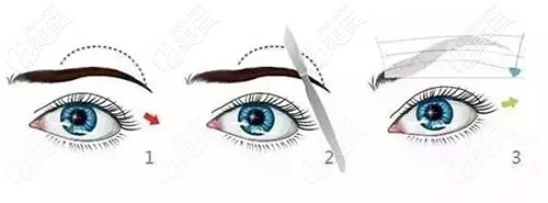 內(nèi)懸吊提眉術(shù)原理 內(nèi)懸吊提眉術(shù)原理