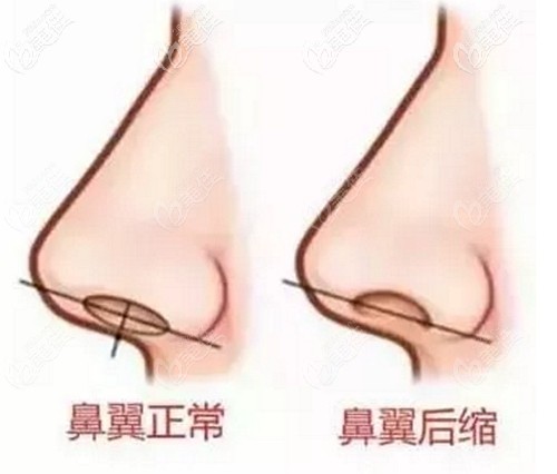 正常鼻翼和鼻翼緣后縮的對(duì)比