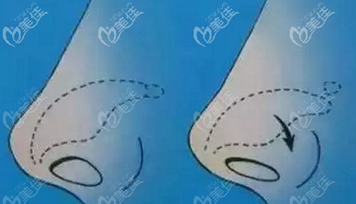 輕度鼻翼緣后縮該如何修復(fù)