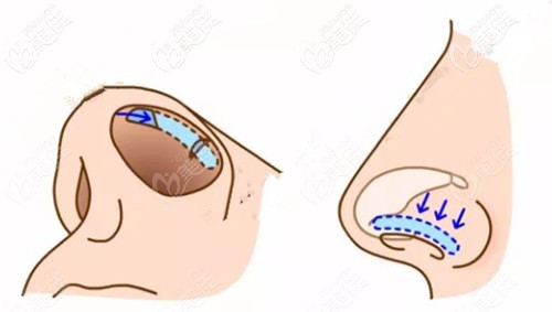 鼻翼緣后縮修復(fù)手術(shù)方法