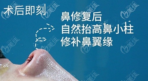 鼻翼緣后縮修復(fù)后的效果