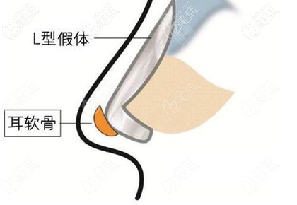 耳后筋膜隆鼻和耳軟骨隆鼻不一樣