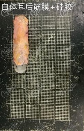 耳后筋膜包裹假體能避免術(shù)后透光