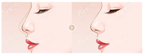 我做了耳后筋膜鼻修復(fù)效果