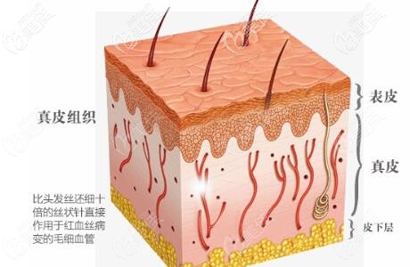 激光去紅血絲過(guò)程 激光去紅血絲過(guò)程